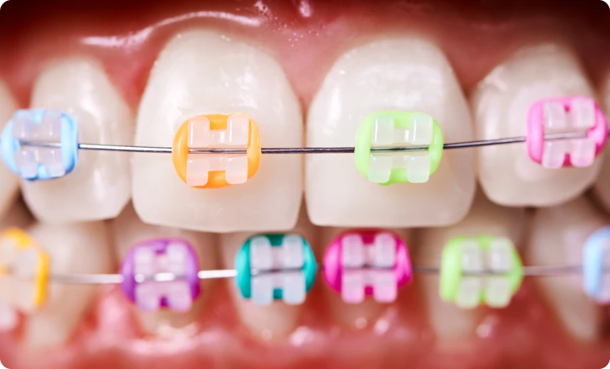 appareils dentaires sinus lift nueil les aubiers Appareils dentaires Jeunesse