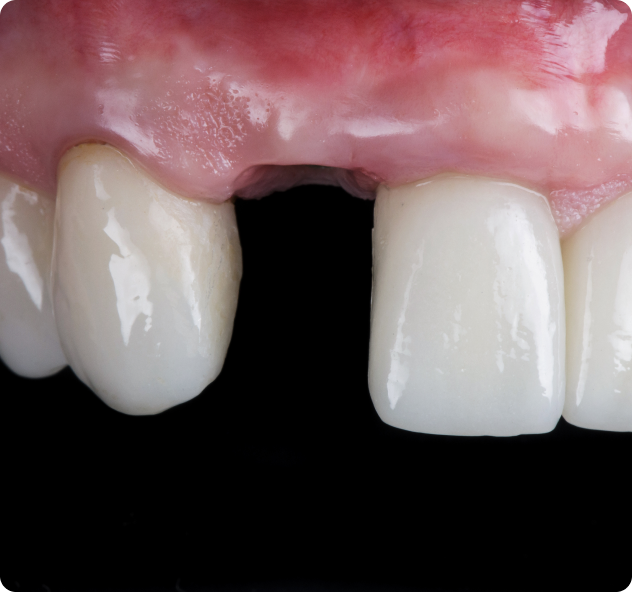 Perte de dent non compensée