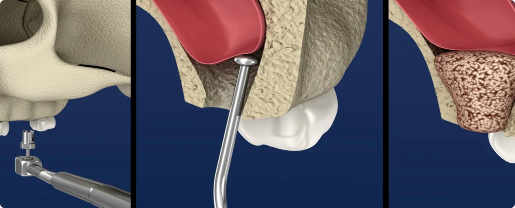 rehabilitation complete greffe osseuse nueil les aubiers Greffe de sinus Jeunesse