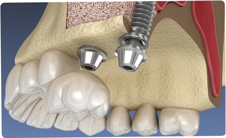 sinus lift dentaires nueil les aubiers Greffe de sinus Jeunesse