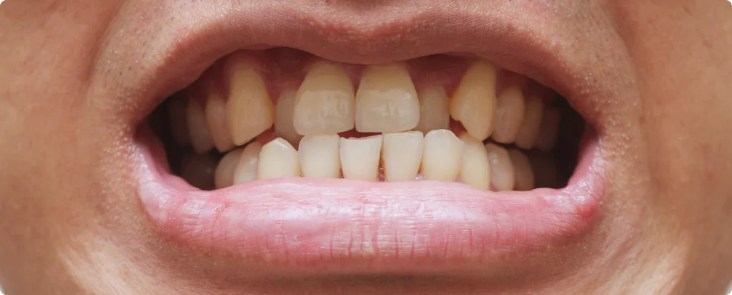 appareils dentaires aligneurs invisibles nueil les aubiers Mauvais alignement dentaire Jeunesse