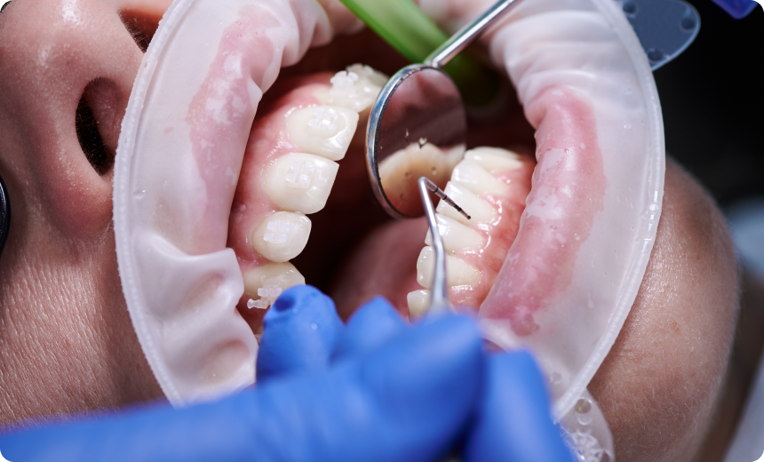 chirurgie orale greffe osseuse nueil les aubiers Surfaçage Jeunesse