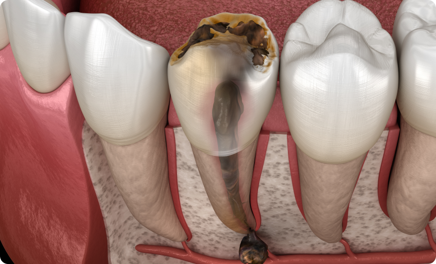 extraction implantation immediate rehabilitation complete nueil les aubiers Kystes Jeunesse