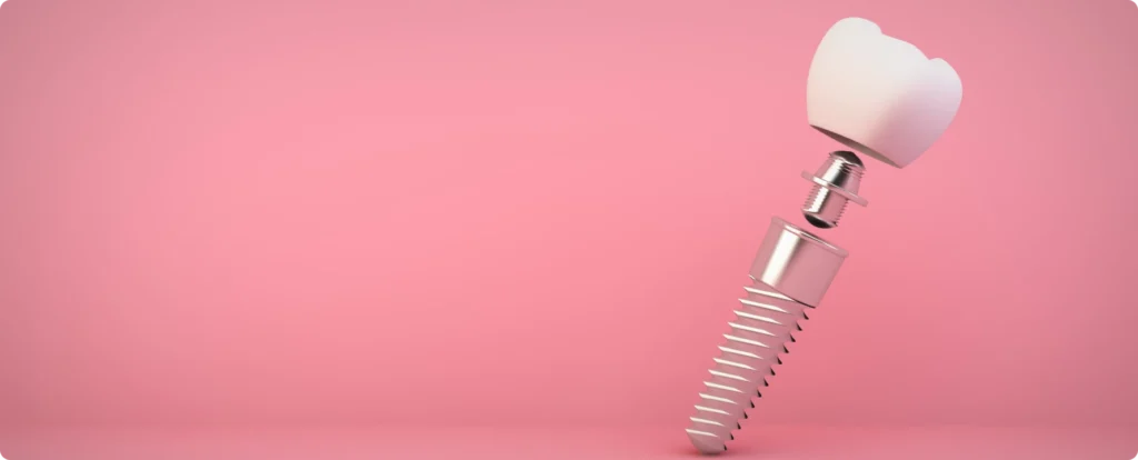 implant dentaire nueil les aubiers Implant dentaire près de Thouars Jeunesse