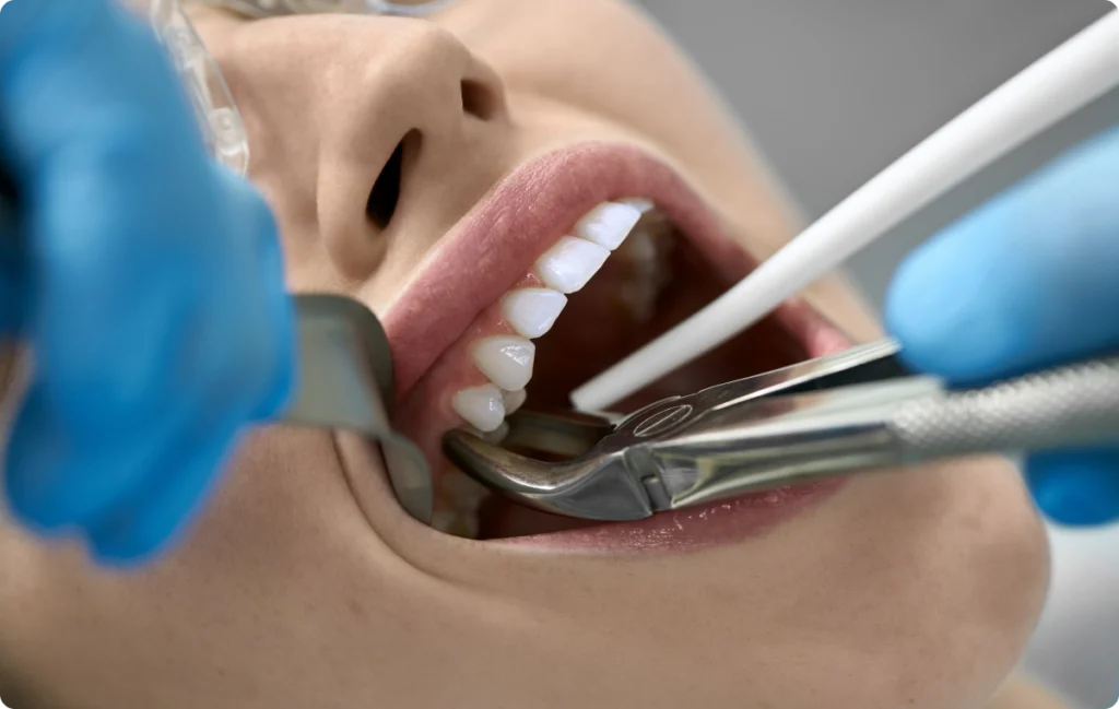 extraction implantation immediate greffe osseuse nueil les aubiers Extraction dentaire Jeunesse